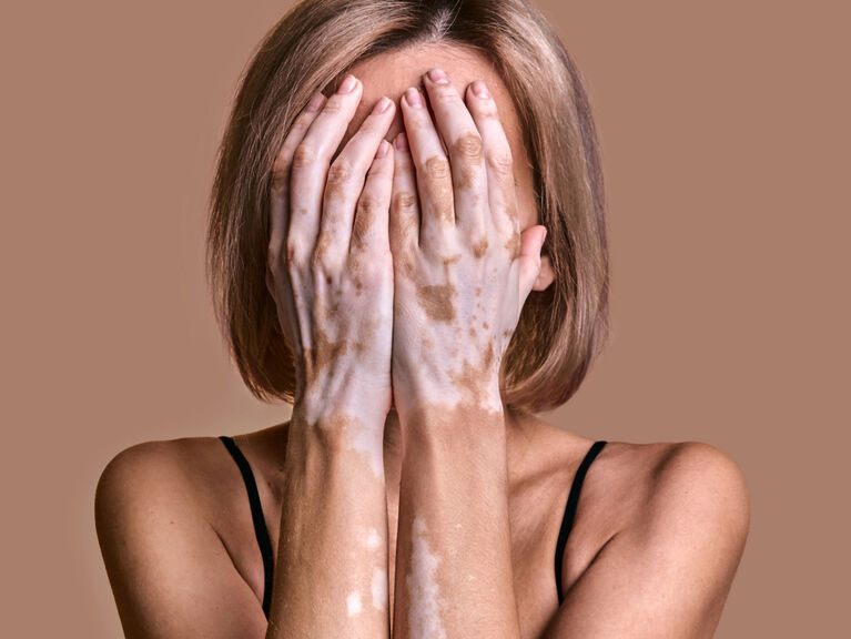 Frau mit Weißfleckenkrankheit Frau mit Weißfleckenkrankheit